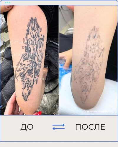 Удаление татуировки